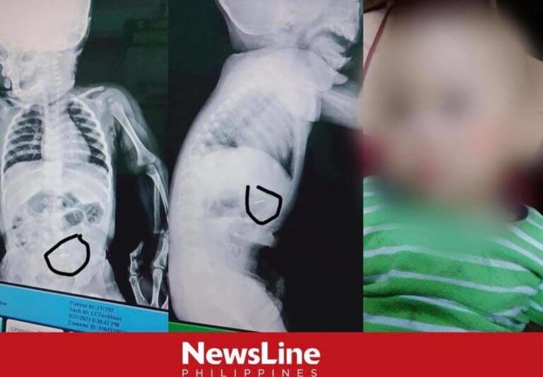 9-month old baby swallows push pin, released it after 26 hours