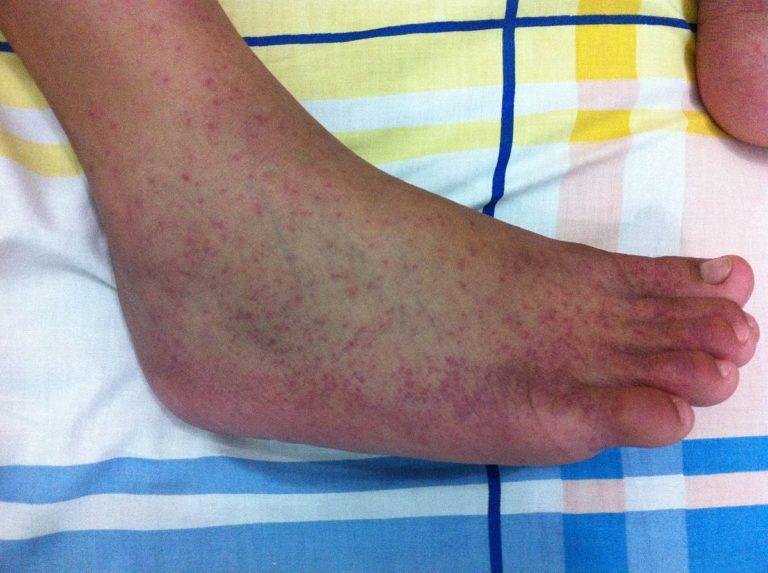 2 Davao City villages monitored for possible chikungunya cases