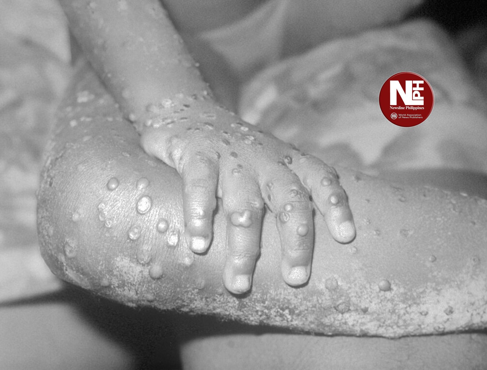 MONKEYPOX WEB